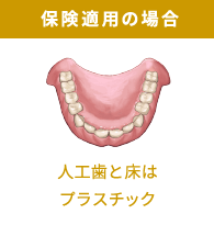 保険適用の場合：人工歯と床はプラスチック