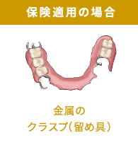 保険適用の場合：金属のクラスプ（留め具）