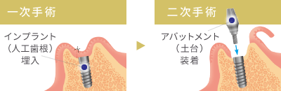 インプラント（人工歯根）埋入する一次手術とアバットメント（土台）装着する二次手術