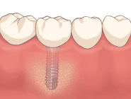 インプラント
