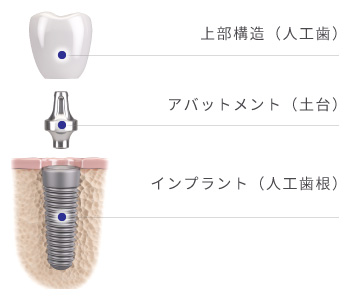 「上部構造（人工歯）」「アバットメント（土台）」「インプラント（人工歯根）」でインプラントは構成されます
