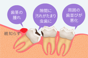 親知らずが原因で起こる症状：歯茎の腫れ,隙間に汚れがたまり虫歯に,周囲の歯並びが悪化